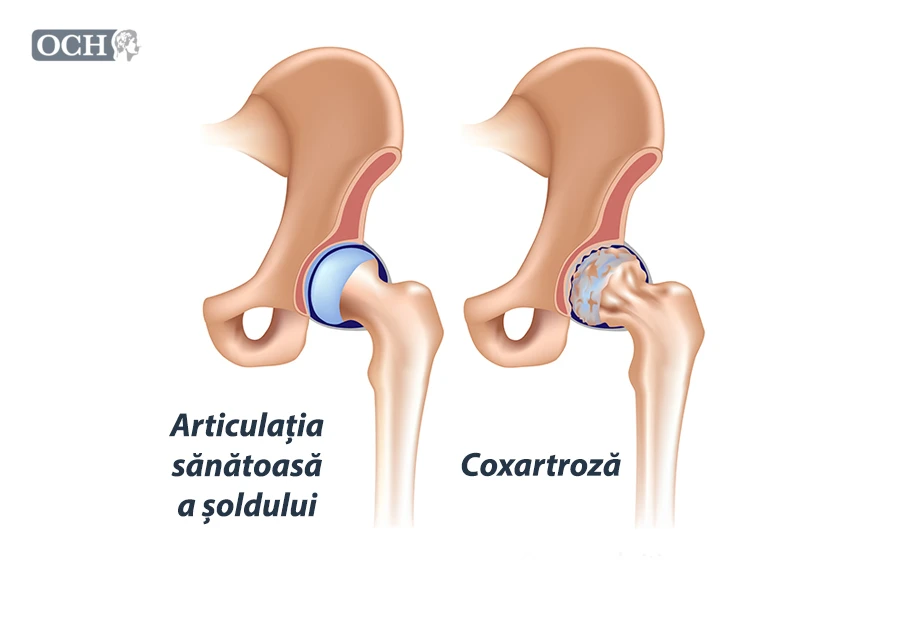 Coxartroză (artroza șoldului) - cauze, simptome și tratament naturist